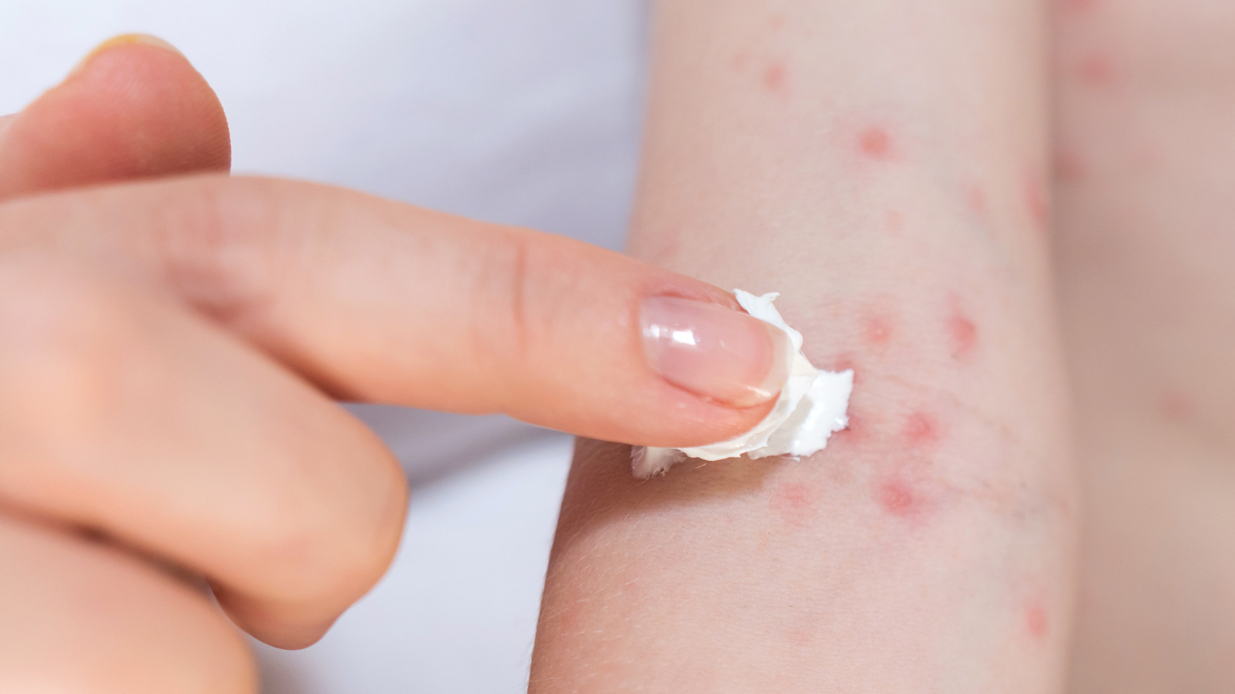 10 Bahan Alami yang Bisa Meredakan Alergi Kulit
